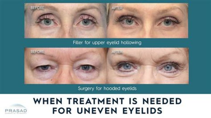 Discover The Allure Of Uneven Eyelid Celebrities
